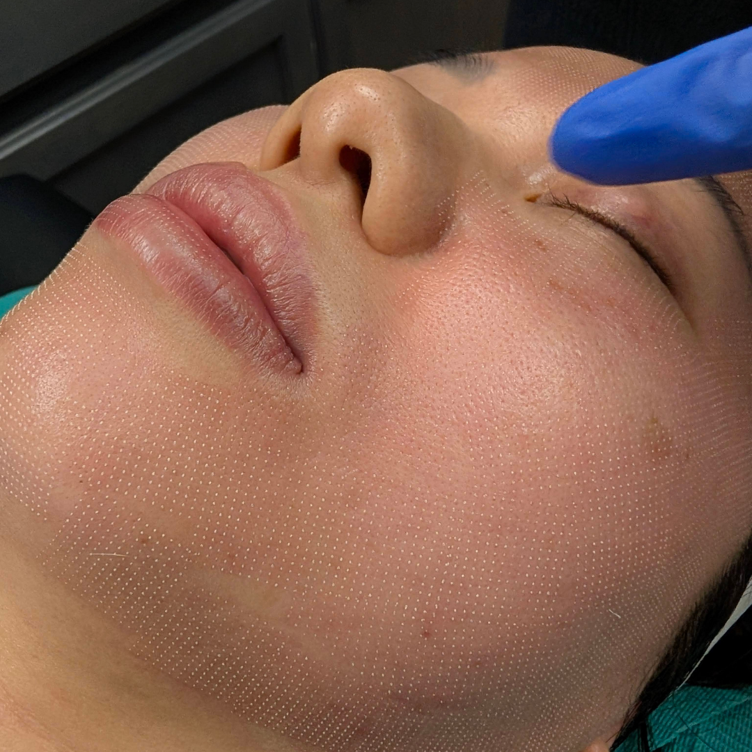 CO2 Laser Resurfacing Phoenix AZ | Vis Vitalis| Dr Kensive Nguyen